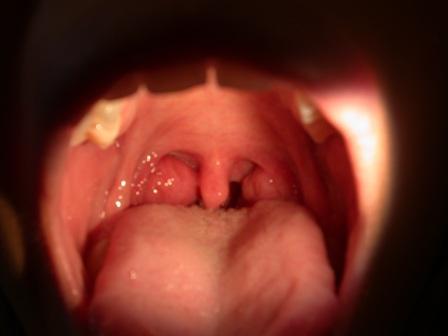 Tonsils i barnet er forstørret: Årsagerne og de vigtigste behandlingsmetoder