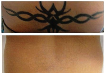 Laser tatovering fjernelse: før og efter. Anmeldelser om laser tattoo fjernelse