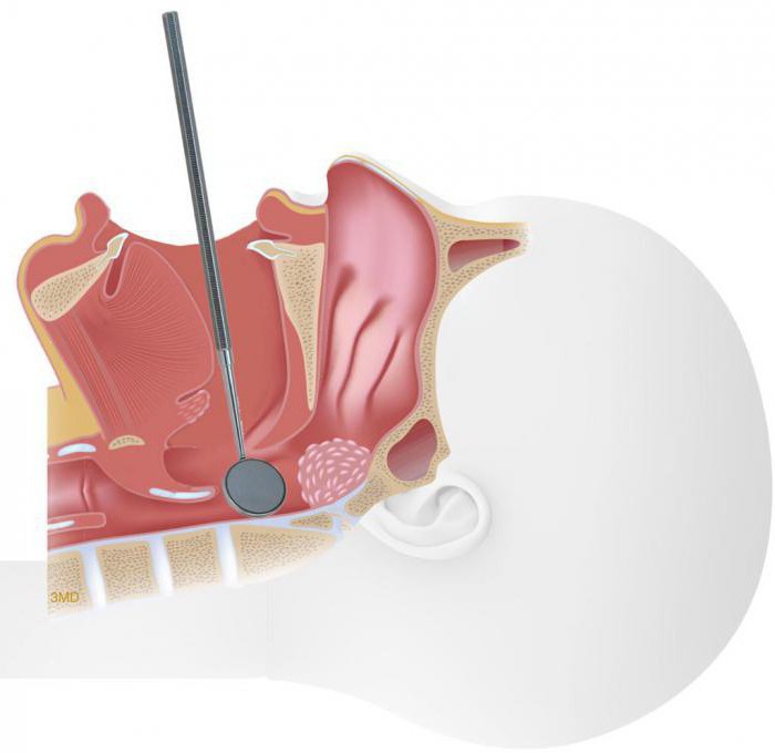 Adenoid: Hvad er det, symptomer, behandling, fjernelse