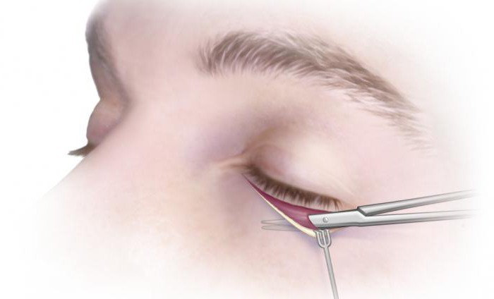 blepharoplasty moscow kirurger