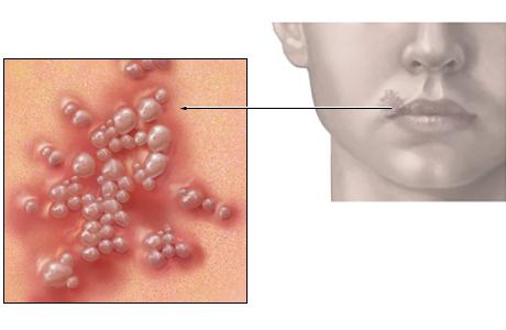 Hvad forårsager udslæt på huden i form af bobler?