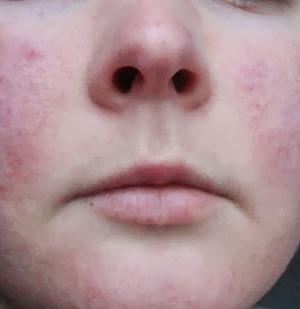 Hvad er oral dermatitis?