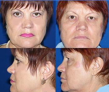 Hvad er øvre øjenlåg blepharoplasty?