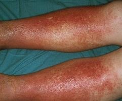 atopisk dermatitis på benene