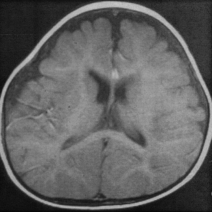 moderat udtrykt ekstern hydrocephalus