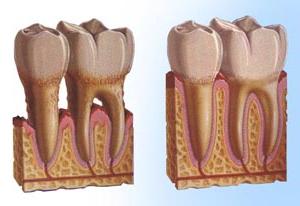 Periodontitis: Symptomer og retsmidler