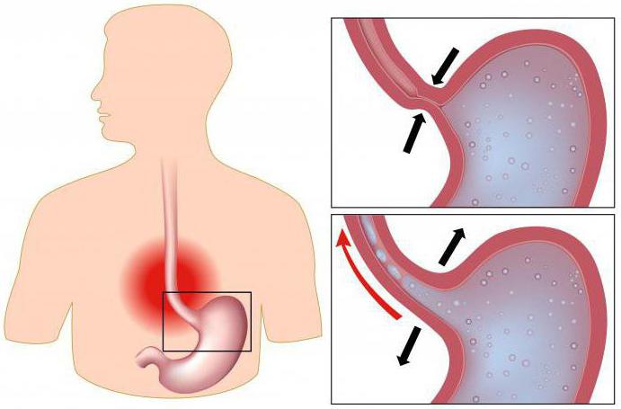 esophagitis