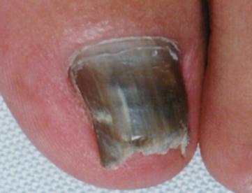 onychomycosis neglebehandling