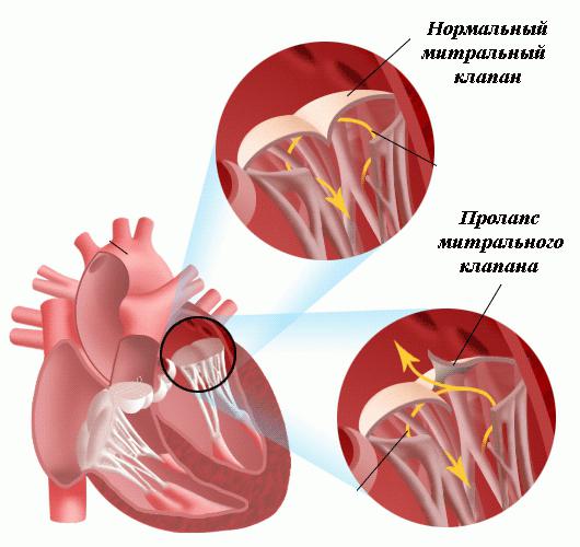 mitral ventil prolaps symptomer