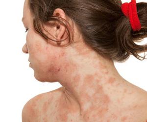 Atopisk dermatitis hos voksne symptomer