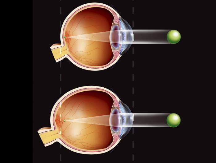 vitamindråber for øjnene, der er bedre for glaukom